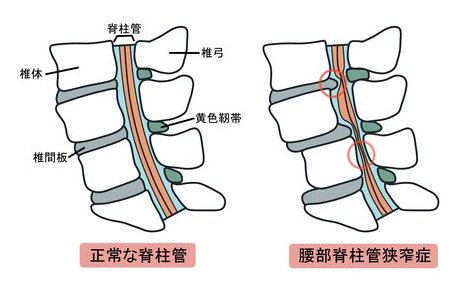 反り腰も脊柱管狭窄症のリスクになります